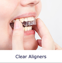 Clear Aligners